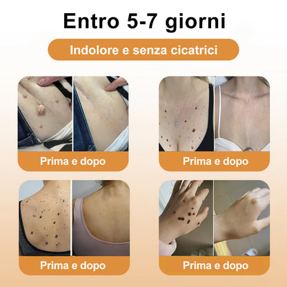 🌼🌼[💦Negozio ufficiale del marchio💦] Zoencgz™ Crema trattante al veleno d'api e verruche（👨‍⚕EMA Certificazione）