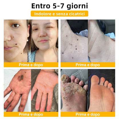 🌼🌼[💦Negozio ufficiale del marchio💦] Zoencgz™ Crema trattante al veleno d'api e verruche（👨‍⚕EMA Certificazione）